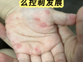 手机口病的症状